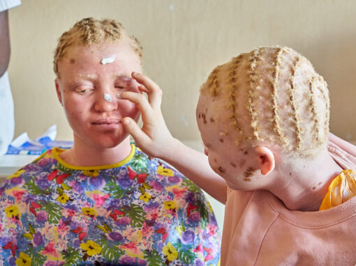 Defensa de los derechos humanos de las personas con albinismo en Malaui, mediante la mejora del acceso a atención sanitaria especializada y la promoción de su inclusión social